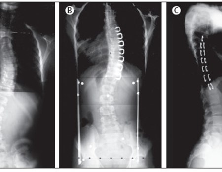 La Scoliosi e il corsetto tipo Cheneau