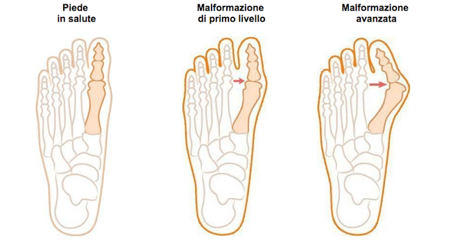 Alluce valgo infiammato, rimedi e cure