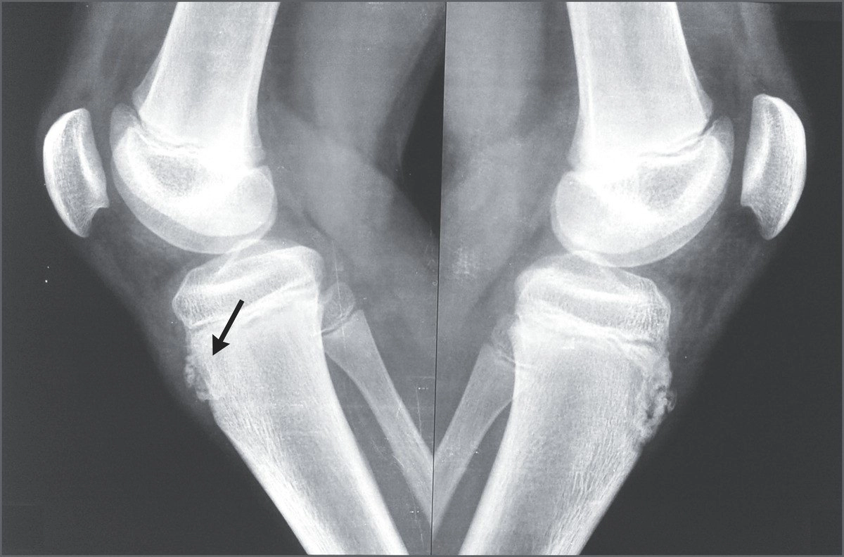 sindrome-di-osgood-schlatter